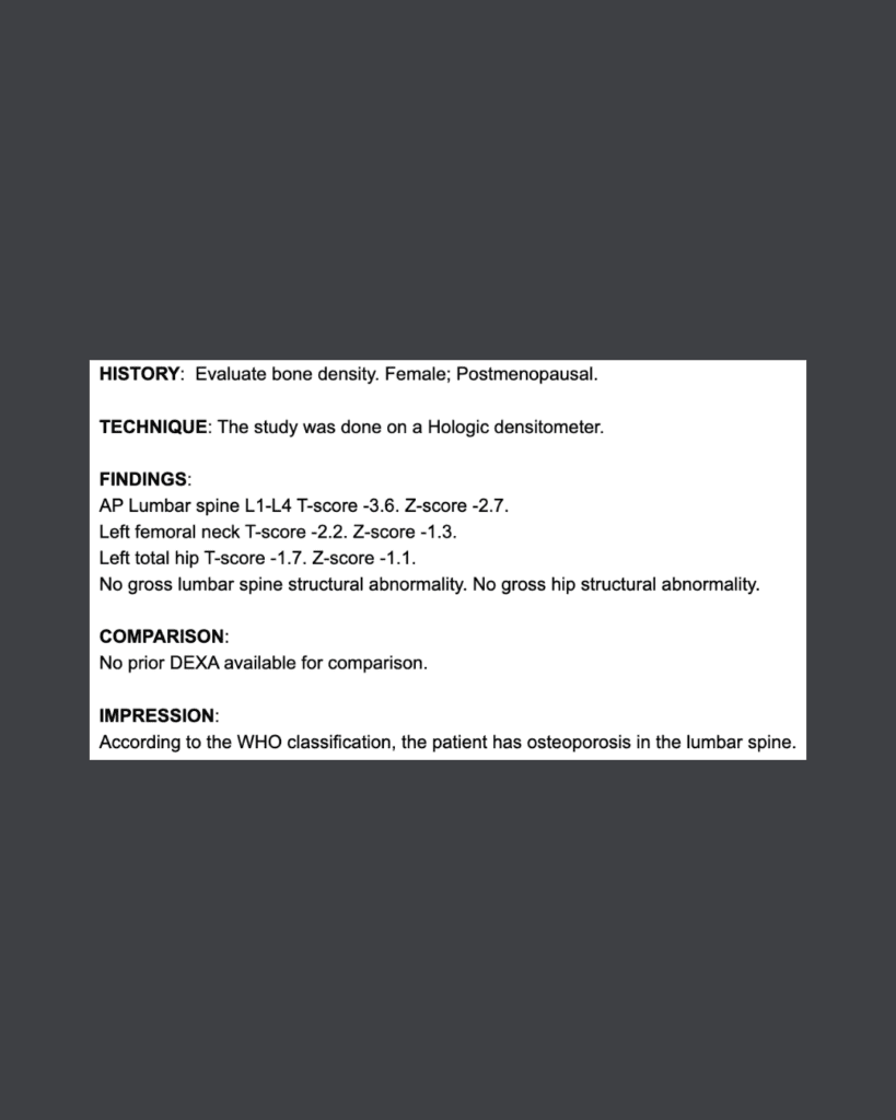 Medical DEXA scan report showing bone density results with osteoporosis diagnosis in lumbar spine, T-scores and findings clearly displayed